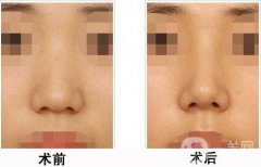上海膨體隆鼻多少費用？上海膨體隆鼻多少錢？