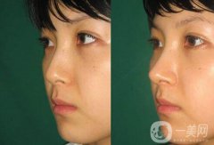 廣東膨體隆鼻整形多少錢？廣東膨體隆鼻費用？