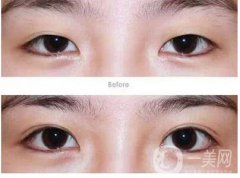 割雙眼皮要多久恢復(fù)？割雙眼皮恢復(fù)時間？