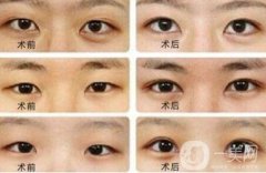 開眼角大概多少錢？開眼角價格一般是多少？