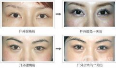 開眼角增生多久恢復(fù)?開眼角增生恢復(fù)時間？