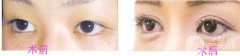 開眼角留疤痕怎么辦？開眼角會留疤嗎？