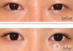 開眼角疼嗎？開眼角痛不痛？