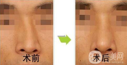 歪鼻矯正一般多少錢？歪鼻矯正手術價格詳細解析