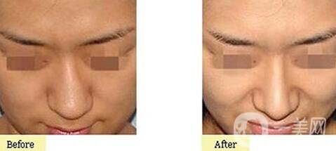 歪鼻矯正一般多少錢？歪鼻矯正手術價格詳細解析