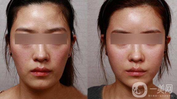 北京朝陽(yáng)醫(yī)院范巨峰做面部自體脂肪填充怎么樣