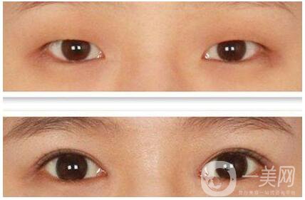 割雙眼皮和開眼角*果好嗎 *果圖分享