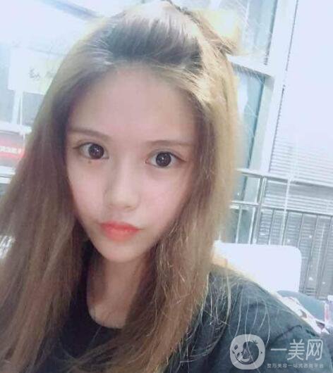 成都開眼角價位是多少 開眼角需要花費多少錢