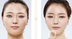 臉部削骨手術(shù)多少錢？削骨瘦臉價格詳解