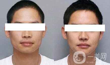 臉部削骨手術(shù)多少錢？削骨瘦臉價格詳解