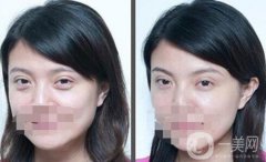 北京去眼袋手術(shù)多少錢？去眼袋價格詳細(xì)解析