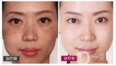 激光調(diào)節(jié)黃褐斑要多少錢？激光祛黃褐斑價格價格分析