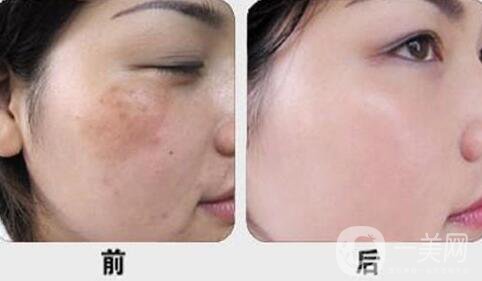 激光調(diào)節(jié)黃褐斑要多少錢？激光祛黃褐斑價格價格分析