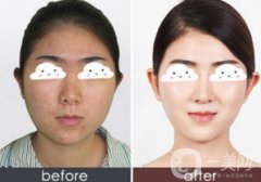 光子嫩膚果怎么樣？光子嫩膚多長時間做一次？