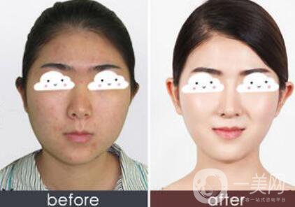 光子嫩膚*果怎么樣？光子嫩膚多長時間做一次？