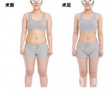 超聲波吸脂減肥果怎么樣？超聲波吸脂減肥多少錢？　　