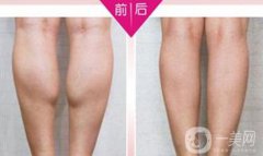 注射瘦腿果好嗎？注射瘦腿多少錢一針？