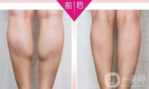 **果好嗎？*多少錢一針？