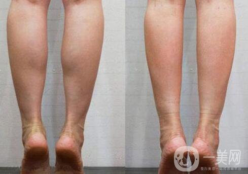 **果好嗎？*多少錢一針？