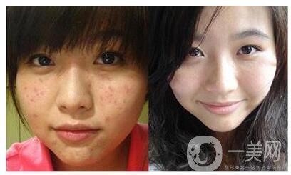 廣州e光祛痘價(jià)格貴不貴？多少錢？