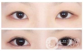 北京開(kāi)眼角費(fèi)用需要多少錢(qián)