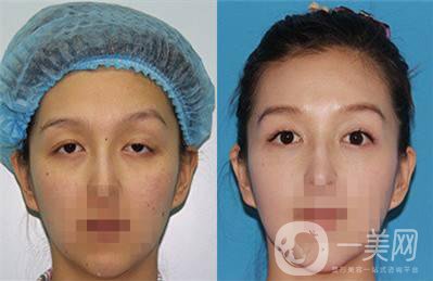 上瞼下垂矯治術(shù)多少錢？詳細(xì)價(jià)格盤點(diǎn)~