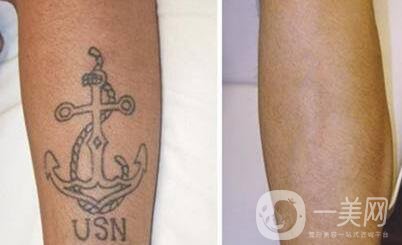 醫(yī)院洗紋身價格 收費明細(xì)詳解