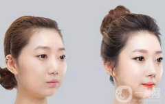 咬肌切除手術(shù)多少錢？切除咬肌價格收費明細(xì)~