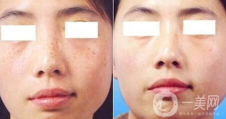 去雀斑價(jià)格 去雀斑價(jià)收費(fèi)明細(xì)說明