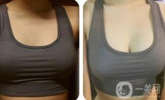 隆乳多少錢 隆胸價格與那些因素有關(guān)