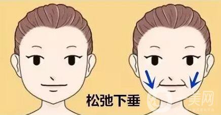 去鼻唇溝多少錢 價格明細盤點