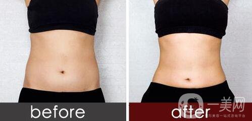 吸脂手術(shù)*嗎？如何降低風(fēng)險？