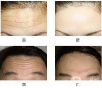 抬頭紋怎么去？去抬頭紋的方法？