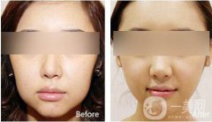 改臉型要多少錢？改臉型價格是多少？