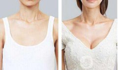 妙桃假體隆胸多少錢？妙桃假體隆胸價格？