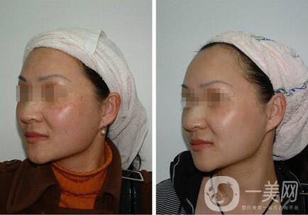 激光祛除黃褐斑要幾次