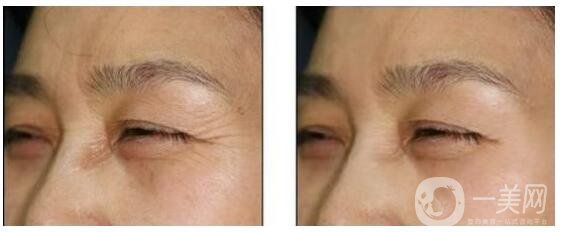 眼角皺紋怎么樣祛除 祛除眼角魚(yú)尾紋的方法