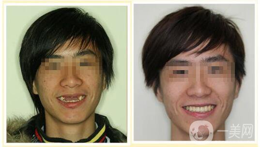 種植牙的利與弊 種植牙的優(yōu)勢缺點分析