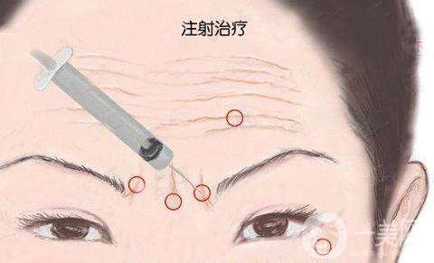 怎樣除去抬頭紋?快速去抬頭紋方法推薦