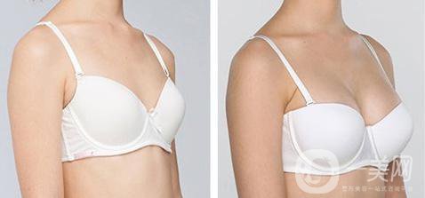隆胸材料有哪些牌子？有哪些優(yōu)缺點(diǎn)？