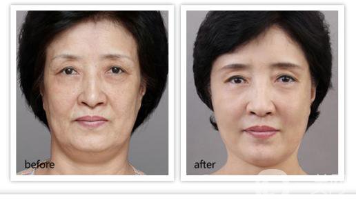 *除皺價(jià)格是多少錢(qián)？有哪些影響因素？