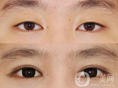 高分子雙眼皮是*嗎?高分子雙眼皮適合哪些人？