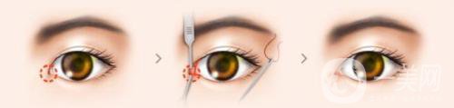 開眼角有危險(xiǎn)嗎？有些什么后遺癥？