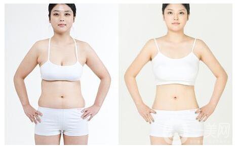 深圳做環(huán)形吸脂價格要多少錢