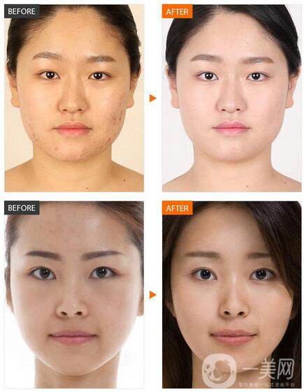 果酸換膚好嗎 果酸嫩膚好不好