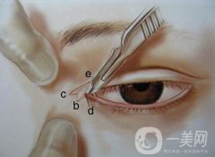 開眼角有風(fēng)險(xiǎn)嗎？開眼角風(fēng)險(xiǎn)有哪些？