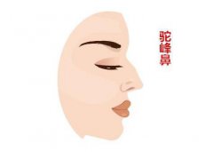 駝峰鼻矯正方法？如何矯正駝峰鼻