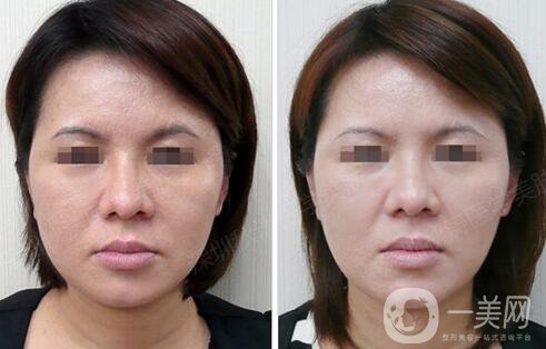 光子嫩膚大概要多少錢？光子嫩膚價(jià)格詳解