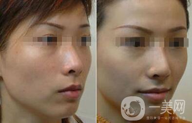 光子嫩膚大概要多少錢？光子嫩膚價(jià)格詳解