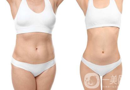 南京吸脂減肥價格是多少？收費明細~